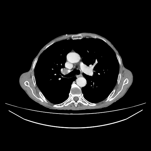 Cerebellar metastasis - lung tumor (Radiopaedia 69317-79150 A 14).jpg