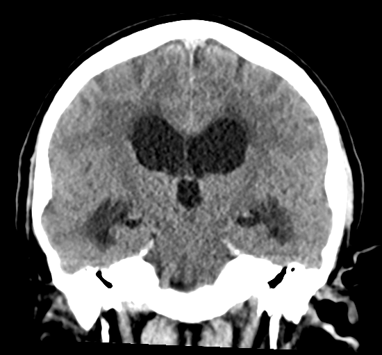 File:Cerebellar metastasis from lung adenocarcinoma (Radiopaedia 86690-102828 Coronal non-contrast 21).png