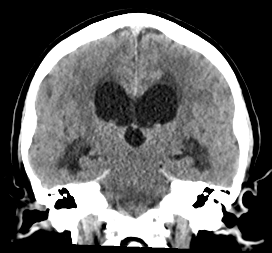 File:Cerebellar metastasis from lung adenocarcinoma (Radiopaedia 86690-102828 Coronal non-contrast 22).png