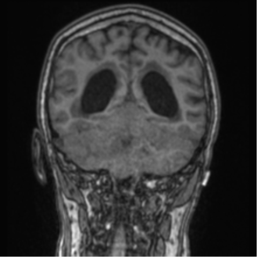 Cerebellar metastasis from lung adenocarcinoma (Radiopaedia 86690-102829 Coronal T1 36).png