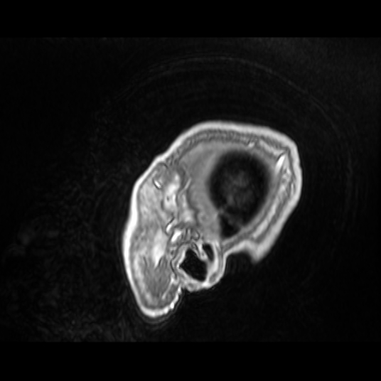 Cerebellar metastasis of pulmonary adenocarcinoma, cavernous venous malformation, and developmental venous anomaly (Radiopaedia 85827-101661 Sagittal T1 C+ 12).jpg