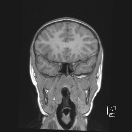 Cerebellar stroke (Radiopaedia 32202-33150 Coronal T1 19).png