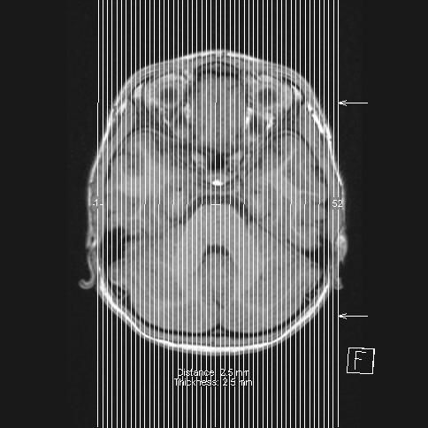 Cerebellar stroke (Radiopaedia 32202-33150 Sagittal T1 C+ 53).png
