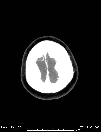 Cerebellar strokes due to intracranial giant cell arteritis (Radiopaedia 68799-78510 CT angiogram 11).jpg