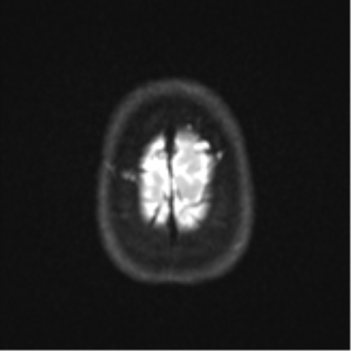 Cerebellar tuberculomas (Radiopaedia 46939-51472 Axial DWI 27).png