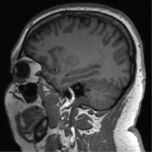 Cerebellopontine angle meningioma (Radiopaedia 48434-53348 Sagittal T1 63).png