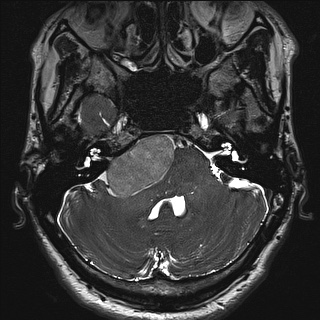 Cerebellopontine angle meningioma (Radiopaedia 72983-83680 Axial FIESTA 27).jpg