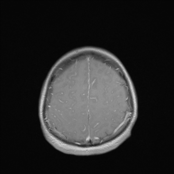 Cerebral abscess (Radiopaedia 24212-24478 Axial T1 C+ 48).jpg