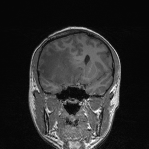 Cerebral abscess (Radiopaedia 24212-24478 Coronal T1 88).jpg