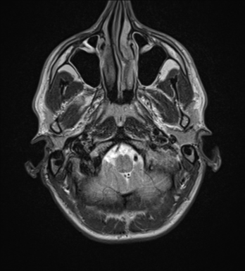 File:Cerebral abscess (Radiopaedia 60342-68009 Axial T2 2).png