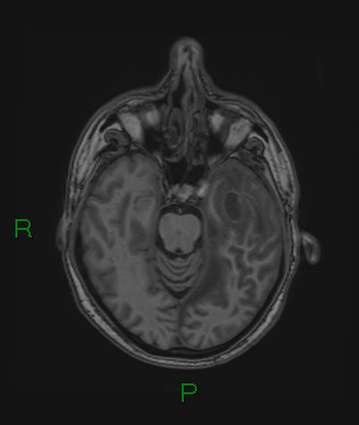 Cerebral abscess and subdural empyema (Radiopaedia 84436-99779 Axial T1 56).jpg
