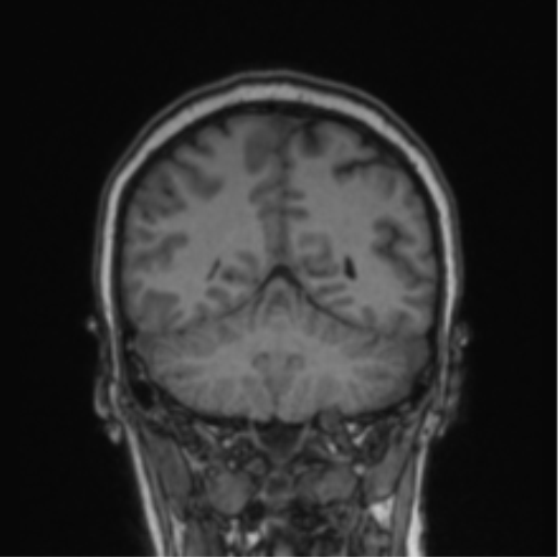 Cerebral abscess from pulmonary arteriovenous malformation (Radiopaedia 86275-102291 Coronal T1 29).png