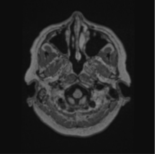 Cerebral abscess from pulmonary arteriovenous malformation (Radiopaedia 86275-102291 J 11).png