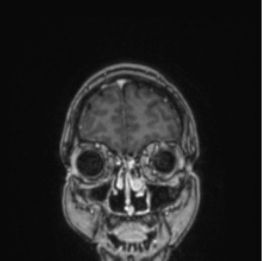 File:Cerebral abscess from pulmonary arteriovenous malformation (Radiopaedia 86275-102291 L 77).png