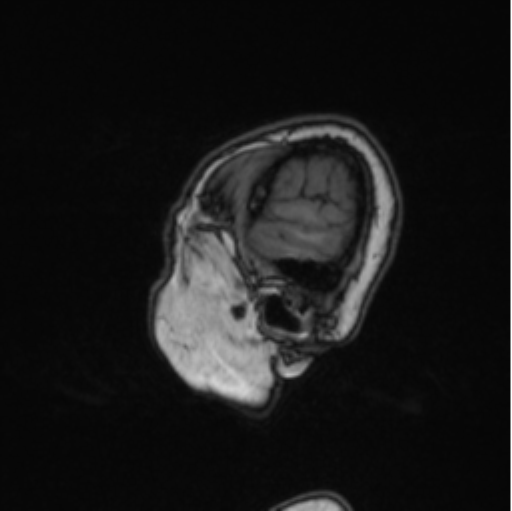Cerebral abscess from pulmonary arteriovenous malformation (Radiopaedia 86275-102291 Sagittal T1 84).png