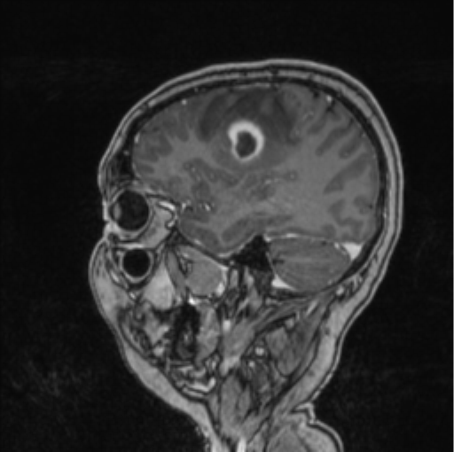 Cerebral abscess from pulmonary arteriovenous malformation (Radiopaedia 86275-102291 Sagittal T1 C+ 56).png