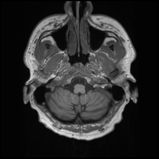 File:Cerebral abscess with ventriculitis (Radiopaedia 78965-91878 Axial T1 6).jpg