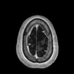 Cerebral amyloid angiopathy (Radiopaedia 29129-29518 Axial T1 C+ 136).jpg