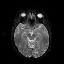 Cerebral amyloid angiopathy (Radiopaedia 77506-89664 Axial DWI 40).jpg