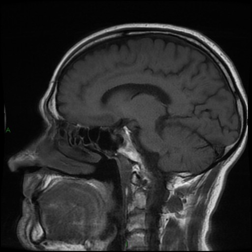 File:Cerebral amyloid angiopathy (Radiopaedia 77506-89664 Coronal T1 16).jpg