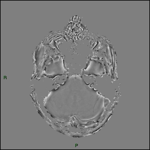 Cerebral amyloid angiopathy (Radiopaedia 77506-89664 H 29).jpg