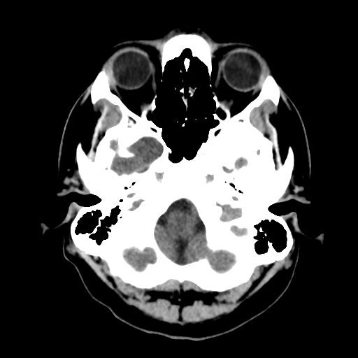 File:Cerebral arteriovenous malformation (Radiopaedia 39259-41505 Brain Ax 5mm 4).png