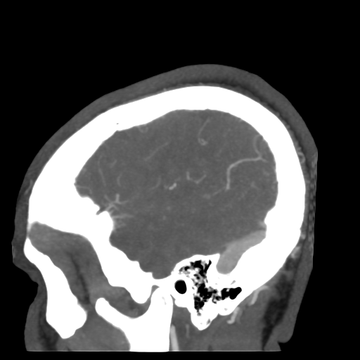 Cerebral arteriovenous malformation (Radiopaedia 39259-41505 Sagittal 52).png