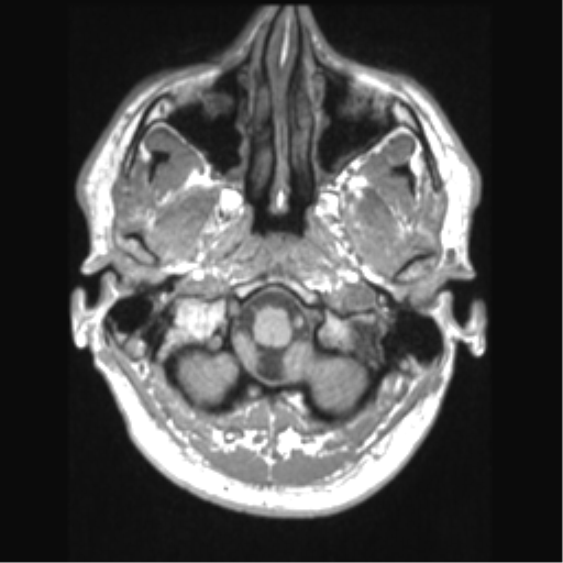 Cerebral arteriovenous malformation (Radiopaedia 39259-41506 Axial T1 11).png
