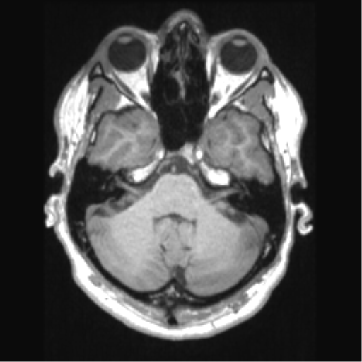 Cerebral arteriovenous malformation (Radiopaedia 39259-41506 Axial T1 20).png