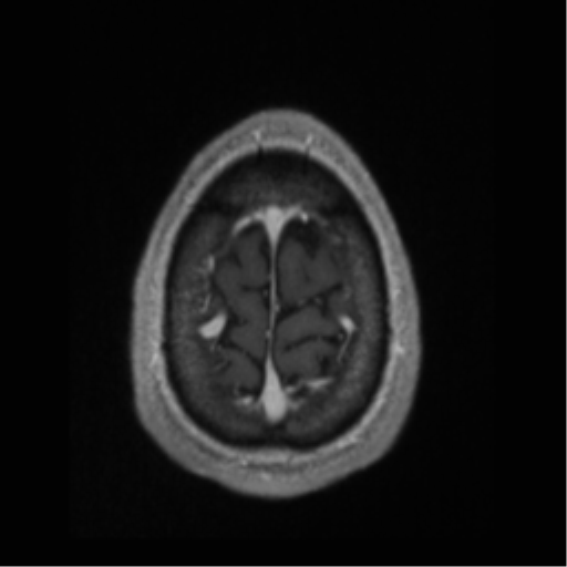 Cerebral arteriovenous malformation (Radiopaedia 55798-62372 Axial T1 C+ 71).png