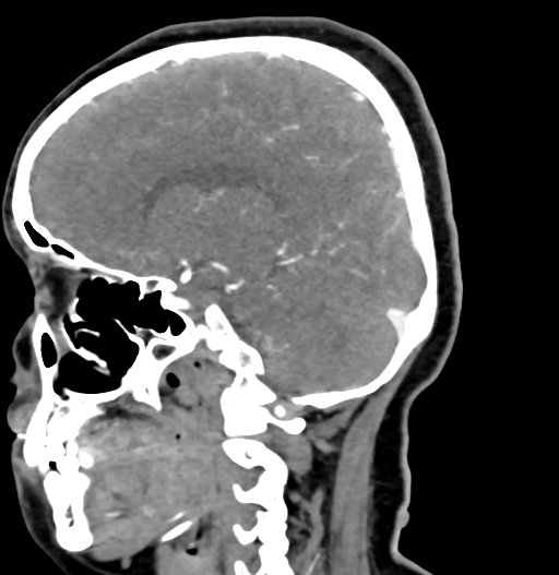 Cerebral arteriovenous malformation (Radiopaedia 73830-84645 D 39).jpg
