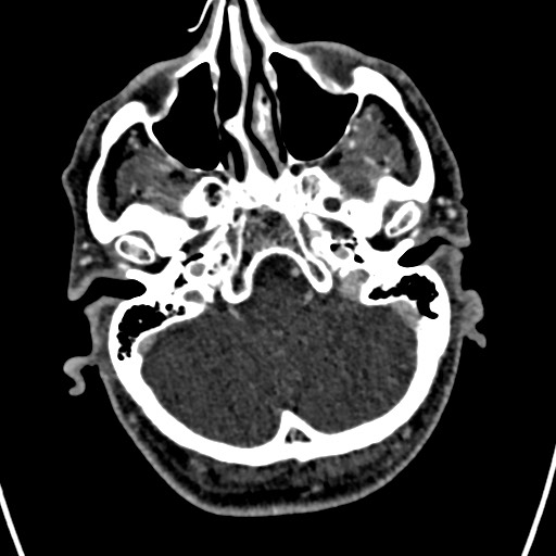 Cerebral arteriovenous malformation (Radiopaedia 78188-90746 Axial C+ delayed 32).jpg