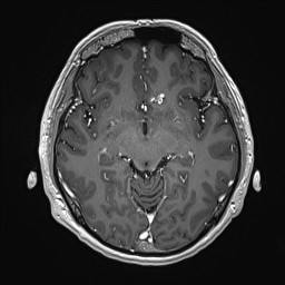 File:Cerebral arteriovenous malformation (Radiopaedia 84015-99245 Axial T1 C+ 71).jpg