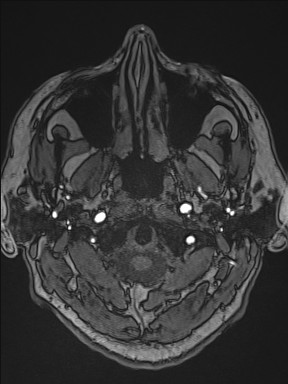 Cerebral arteriovenous malformation (Radiopaedia 84015-99245 Axial TOF 28).jpg