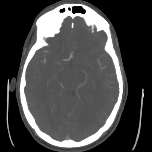 Cerebral arteriovenous malformation (Spetzler-Martin grade 2) (Radiopaedia 41262-44076 E 24).png