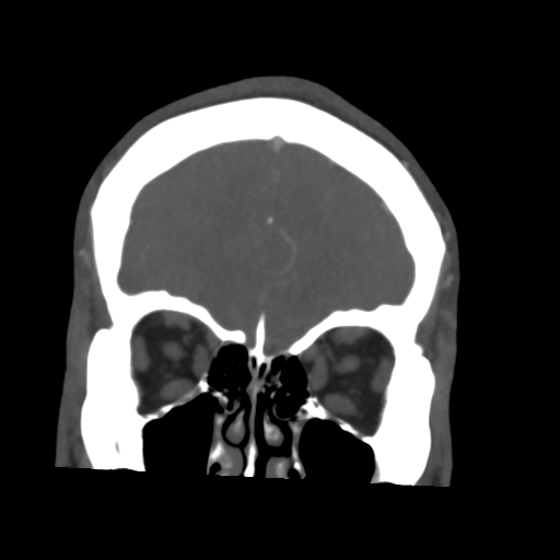 File:Cerebral arteriovenous malformation (Spetzler-Martin grade 2) (Radiopaedia 41262-44076 F 13).png