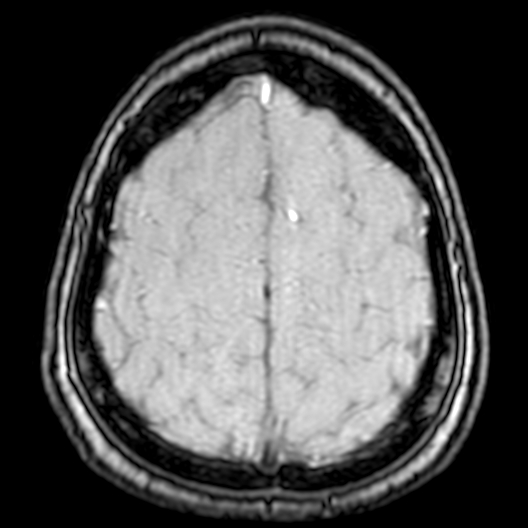 Cerebral arteriovenous malformation at posterior body of corpus callosum (Radiopaedia 74111-84925 Axial MRA 189).jpg