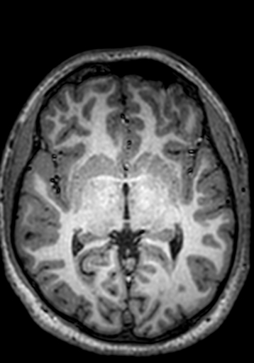 Cerebral arteriovenous malformation at posterior body of corpus callosum (Radiopaedia 74111-84925 Axial T1 160).jpg