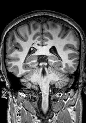 Cerebral arteriovenous malformation at posterior body of corpus callosum (Radiopaedia 74111-84925 Coronal T1 219).jpg