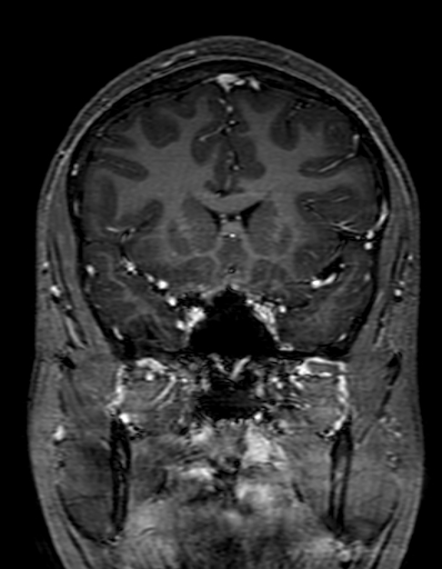 Cerebral arteriovenous malformation at posterior body of corpus callosum (Radiopaedia 74111-84925 K 125).jpg