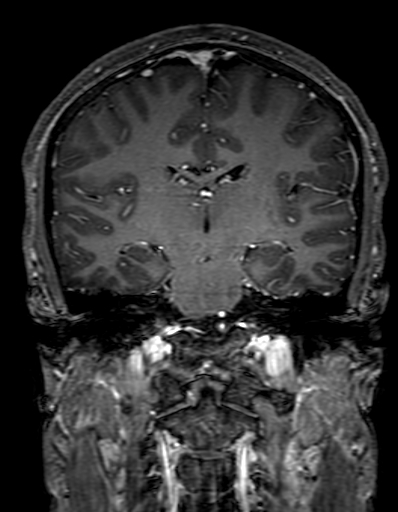 Cerebral arteriovenous malformation at posterior body of corpus callosum (Radiopaedia 74111-84925 K 200).jpg