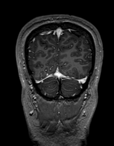 Cerebral arteriovenous malformation at posterior body of corpus callosum (Radiopaedia 74111-84925 K 331).jpg