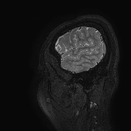 Cerebral arteriovenous malformation at posterior body of corpus callosum (Radiopaedia 74111-84925 Sagittal T2 4).jpg