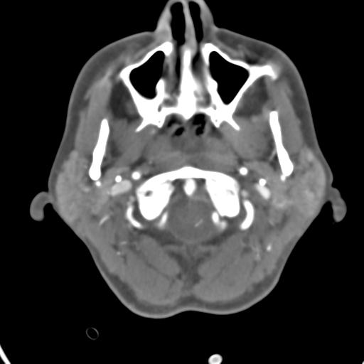 Cerebral arteriovenous malformation with hemorrhage (Radiopaedia 28773-29073 A 51).jpg