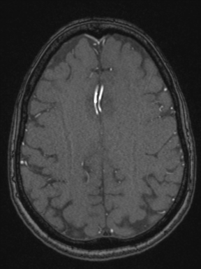 Cerebral arteriovenous malformation with hemorrhage (Radiopaedia 34422-35737 Axial MRA 61).png