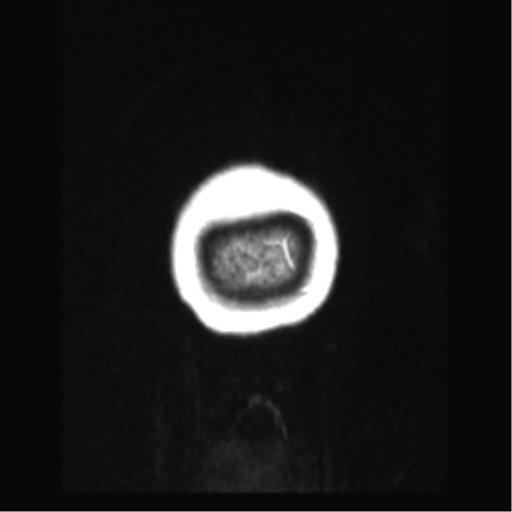 Cerebral arteriovenous malformation with hemorrhage (Radiopaedia 34422-35737 Coronal T1 C+ 2).png