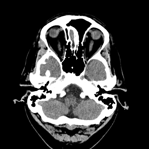 Cerebral arteriovenous malformation with lobar hemorrhage (Radiopaedia 35598-37117 Axial non-contrast 7).jpg