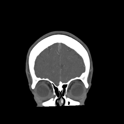 Cerebral arteriovenous malformation with lobar hemorrhage (Radiopaedia 35598-57216 C 14).jpg