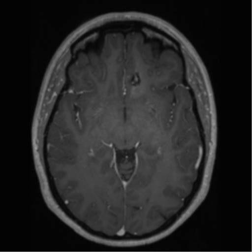 Cerebral cavernoma and development venous anomaly (Radiopaedia 37603-39482 Axial T1 C+ 35).png