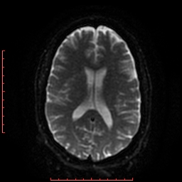 File:Cerebral cavernous malformation (Radiopaedia 26177-26306 Axial DWI 33).jpg